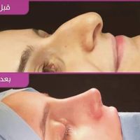 جراحی عمل بینی لیفت لیپوماتیک پروتزپیکرتراشی ژنیکو|خدمات آرایشگری و زیبایی|تهران, میدان ولیعصر|دیوار