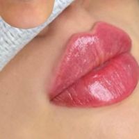 تزریق ژل.بوتاکس.مزوتراپی.فشیال.جوانساز|خدمات آرایشگری و زیبایی|تهران, پیروزی|دیوار