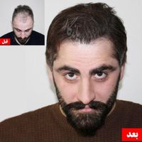 کاشت مو با خط رویش طبیعی و تراکم بالا|خدمات آرایشگری و زیبایی|تهران, عباس‌آباد|دیوار