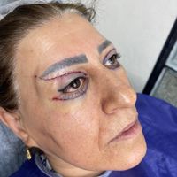 ژل ‌بوتاکس ‌بلفارو  فیلربادی آنزیم لیزر و نخ مزو|خدمات آرایشگری و زیبایی|کرج, گوهردشت|دیوار