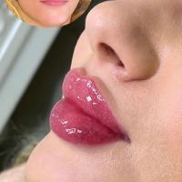 تزریق ژل.بوتاکس.مزوتراپی.فشیال.جوانساز|خدمات آرایشگری و زیبایی|تهران, پیروزی|دیوار