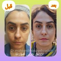 ساکشن تخصصی غبغب بهمراه کانتورینگ و تزریق چربی|خدمات آرایشگری و زیبایی|تهران, شهر زیبا|دیوار