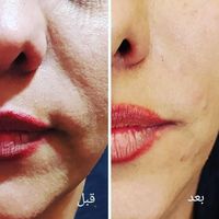 مطب پزشک ژل و بوتاکس ژل لب گونه چونه فیلر بینی|خدمات آرایشگری و زیبایی|قم, صفائیه|دیوار