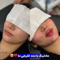 تزریق فیلر ژل لب گونه چونه زاویه خط خنده بوتاکس|خدمات آرایشگری و زیبایی|قم, زنبیل‌آباد (شهید صدوقی)|دیوار