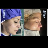 جراحی بینی فقط دو نفربرای سه شنبه|خدمات آرایشگری و زیبایی|تهران, نازی‌آباد|دیوار