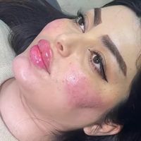 ژل بوتاکس کانتورینگ لیفت بانخ|خدمات آرایشگری و زیبایی|تهران, صادقیه|دیوار