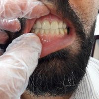 دندانسازی،باضمانت،دندان مصنوعی،دندان سازی|خدمات آرایشگری و زیبایی|مشهد, محله پایین خیابان|دیوار