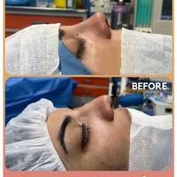 جراحی بینی فقط دو نفربرای سه شنبه|خدمات آرایشگری و زیبایی|تهران, نازی‌آباد|دیوار