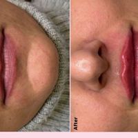 نیاز به مدل رایگان فیلر لب در مطب پزشک زیبایی|خدمات آرایشگری و زیبایی|تهران, سلسبیل|دیوار