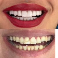 روکش  تمام سرامیکی و لمینت|خدمات آرایشگری و زیبایی|تهران, افسریه|دیوار