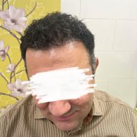 کاشت ابرو مو شقیقه ریش مزو تراپی نچرال طبیعی|خدمات آرایشگری و زیبایی|اصفهان, خانه اصفهان|دیوار