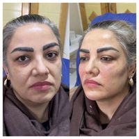 لیفت طبیعی کامل صورت ام دی کد کانتور صورت|خدمات آرایشگری و زیبایی|تهران, میرداماد|دیوار