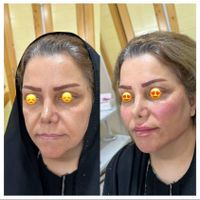 لیفت طبیعی کامل صورت ام دی کد کانتور صورت|خدمات آرایشگری و زیبایی|تهران, میرداماد|دیوار