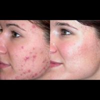 تخصصی پی آر پیprpحرفه ای بوتاکس ژل حجامت70فیلر فصد|خدمات آرایشگری و زیبایی|اصفهان, وحید|دیوار