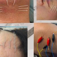 حجامت فصد زالو بادکش طب سوزنی فیزیوتراپی|خدمات آرایشگری و زیبایی|تهران, ایران|دیوار