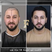 کاشت مو ابرو ریش بدون جراحی با پیشرفته ترین روش|خدمات آرایشگری و زیبایی|تهران, الهیه|دیوار