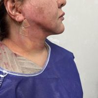 ژل ‌بوتاکس ‌بلفارو  فیلربادی آنزیم لیزر و نخ مزو|خدمات آرایشگری و زیبایی|کرج, گوهردشت|دیوار