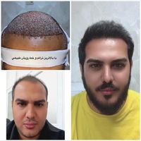 کاشت مو شریفی-تضمینی-۱۸ سال سابقه-تیم شیرازی|خدمات آرایشگری و زیبایی|یزد, |دیوار
