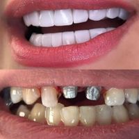 روکش  تمام سرامیکی و لمینت|خدمات آرایشگری و زیبایی|تهران, افسریه|دیوار