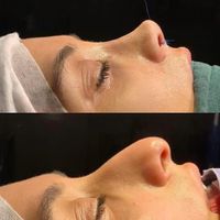 جراحی و عمل زیبایی بینی(رینو پلاستی)|خدمات آرایشگری و زیبایی|کرج, گوهردشت|دیوار
