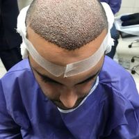 کاشت مو و ابرو در قزوین بیمارستان پاستور|خدمات آرایشگری و زیبایی|قزوین, |دیوار