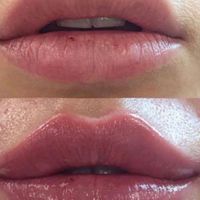 نیاز به مدل رایگان فیلر لب در مطب پزشک زیبایی|خدمات آرایشگری و زیبایی|تهران, سلسبیل|دیوار