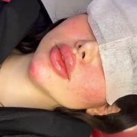 ژل بوتاکس کانتورینگ لیفت بانخ|خدمات آرایشگری و زیبایی|تهران, صادقیه|دیوار