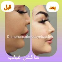 ساکشن تخصصی غبغب بهمراه کانتورینگ و تزریق چربی|خدمات آرایشگری و زیبایی|تهران, شهر زیبا|دیوار