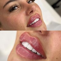 تزریق ژل وبوتاکس عربی،هایفوغبغب،پاک کردن تاتو|خدمات آرایشگری و زیبایی|تهران, نازی‌آباد|دیوار