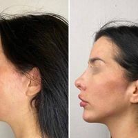 مادلینگ صورت،بوتاکس،لب روسی بانوان و آقایان|خدمات آرایشگری و زیبایی|تهران, توحید|دیوار