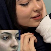 جراحی و عمل بینی/ لیفت صورت در کرج و تهران|خدمات آرایشگری و زیبایی|کرج, جهان‌شهر|دیوار