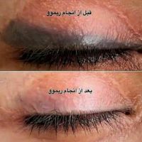 لیزرموهای زائد، تیتانیوم ،پاک کردن تتو،کیوسوئیچ|خدمات آرایشگری و زیبایی|اصفهان, نقش جهان|دیوار
