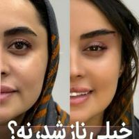 تزریق بوتاکس لیفت صورت وشقیقه فیلر|خدمات آرایشگری و زیبایی|تهران, ستارخان|دیوار