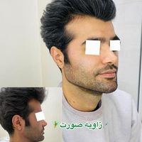 بوتاکس،ژل لب،زاویه،مزو مو،فیلربینی|خدمات آرایشگری و زیبایی|تهران, شهران شمالی|دیوار