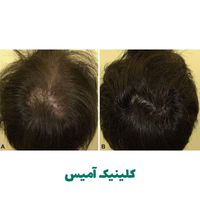 جشنواره هایفو مزوتراپی پی‌ار‌پی بوتاکس خالبرداری|خدمات آرایشگری و زیبایی|تهران, ایوانک|دیوار
