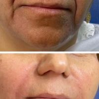 تزریق ژل لب و گونه و چانه و..(جشنواره)درمطب|خدمات آرایشگری و زیبایی|اصفهان, ملک‌شهر|دیوار