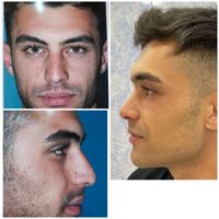 جراحی و عمل زیبایی بینی(رینو پلاستی)|خدمات آرایشگری و زیبایی|کرج, گوهردشت|دیوار
