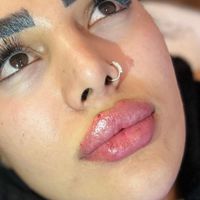 تزریق ژل.بوتاکس.مزوتراپی.فشیال.جوانساز|خدمات آرایشگری و زیبایی|تهران, پیروزی|دیوار