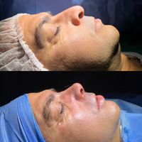 تیپ پلاستی (عمل بینی)|خدمات آرایشگری و زیبایی|تهران, سعادت‌آباد|دیوار