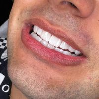 ونیر کامپوزیت دندان پالیش دندانپزشکی پولیش|خدمات آرایشگری و زیبایی|تهران, میرداماد|دیوار