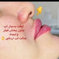 بوتاکس،ژل لب،زاویه،مزو مو،فیلربینی|خدمات آرایشگری و زیبایی|تهران, شهران شمالی|دیوار