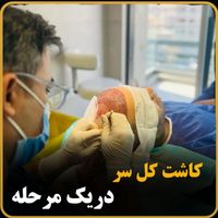 کاشت مو|خدمات آرایشگری و زیبایی|شیراز, فرهنگ شهر|دیوار