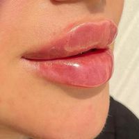 تزریق ژل زیرچشم ،هایفو ،زاویه سازی ، بوتاکس|خدمات آرایشگری و زیبایی|تهران, شهرک شریعتی|دیوار