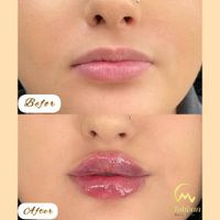 فیلرژل لب بوتاکس فیلر مادلینگ لیزرموهای زائدفشیال|خدمات آرایشگری و زیبایی|تهران, پیروزی|دیوار