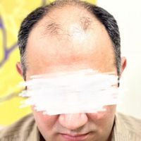 کاشت ابرو مو شقیقه ریش مزو تراپی نچرال طبیعی|خدمات آرایشگری و زیبایی|اصفهان, خانه اصفهان|دیوار