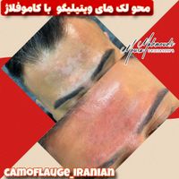 رفع و محو دو رنگی ویتیلیگو|خدمات آرایشگری و زیبایی|تهران, اندیشه (شهر زیبا)|دیوار