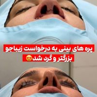 جراحی و عمل بینی/ لیفت صورت در کرج و تهران|خدمات آرایشگری و زیبایی|کرج, جهان‌شهر|دیوار