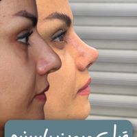 جراحی و عمل بینی/ لیفت صورت در کرج و تهران|خدمات آرایشگری و زیبایی|کرج, جهان‌شهر|دیوار