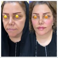 لیفت طبیعی کامل صورت ام دی کد کانتور صورت|خدمات آرایشگری و زیبایی|تهران, میرداماد|دیوار