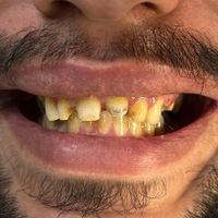 روکش  تمام سرامیکی و لمینت|خدمات آرایشگری و زیبایی|تهران, افسریه|دیوار